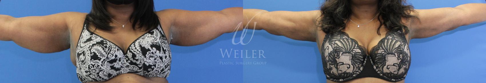 Before & After Liposuction Case 862 Front View in Baton Rouge, New Orleans, & Lafayette, Louisiana