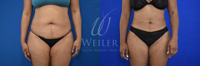 Before & After Liposuction Case 869 Front View in Baton Rouge, New Orleans, & Lafayette, Louisiana