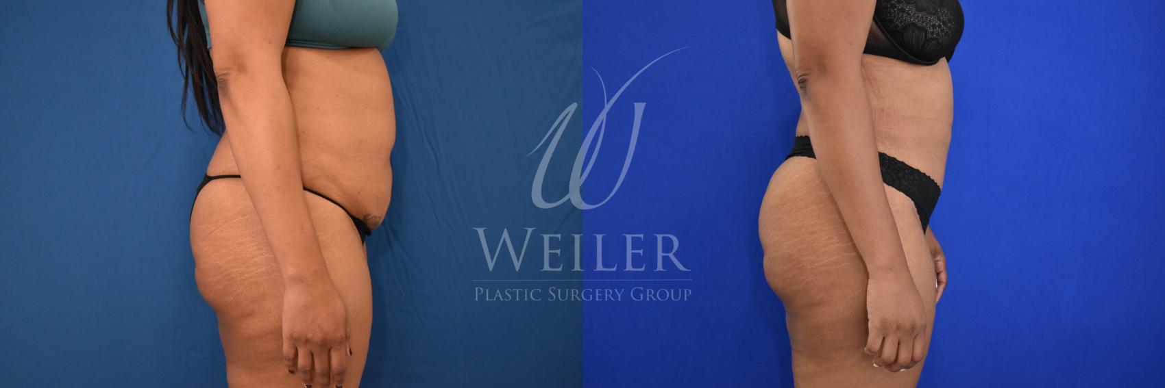 Before & After Liposuction Case 869 Right Side View in Baton Rouge, New Orleans, & Lafayette, Louisiana