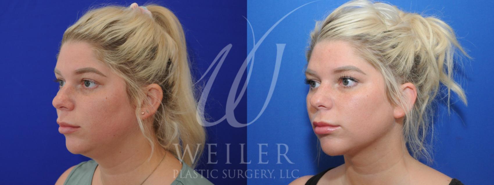 Before & After Liposuction Case 909 Left Oblique View in Baton Rouge, Louisiana
