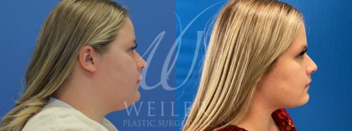 Before & After Liposuction Case 953 Right Oblique View in Baton Rouge, Louisiana