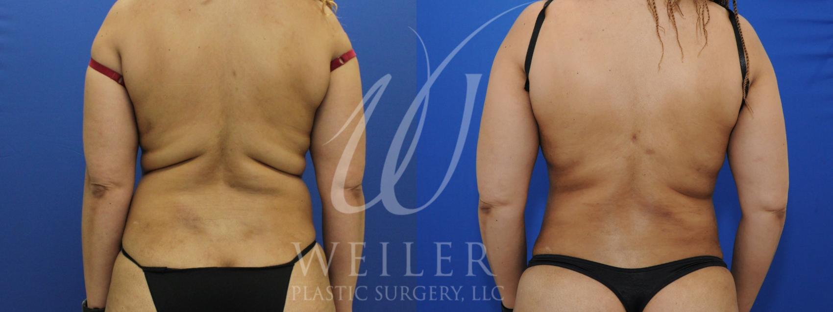 Before & After Liposuction Case 957 Back View in Baton Rouge, New Orleans, & Lafayette, Louisiana