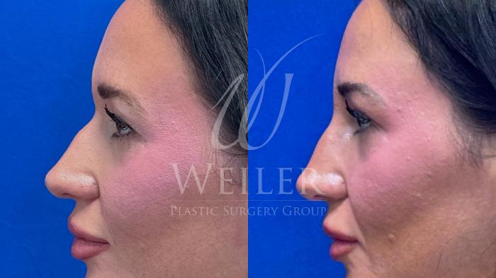 Before & After Liquid Rhinoplasty Case 1658 Left Side View in Baton Rouge, New Orleans, & Lafayette, Louisiana