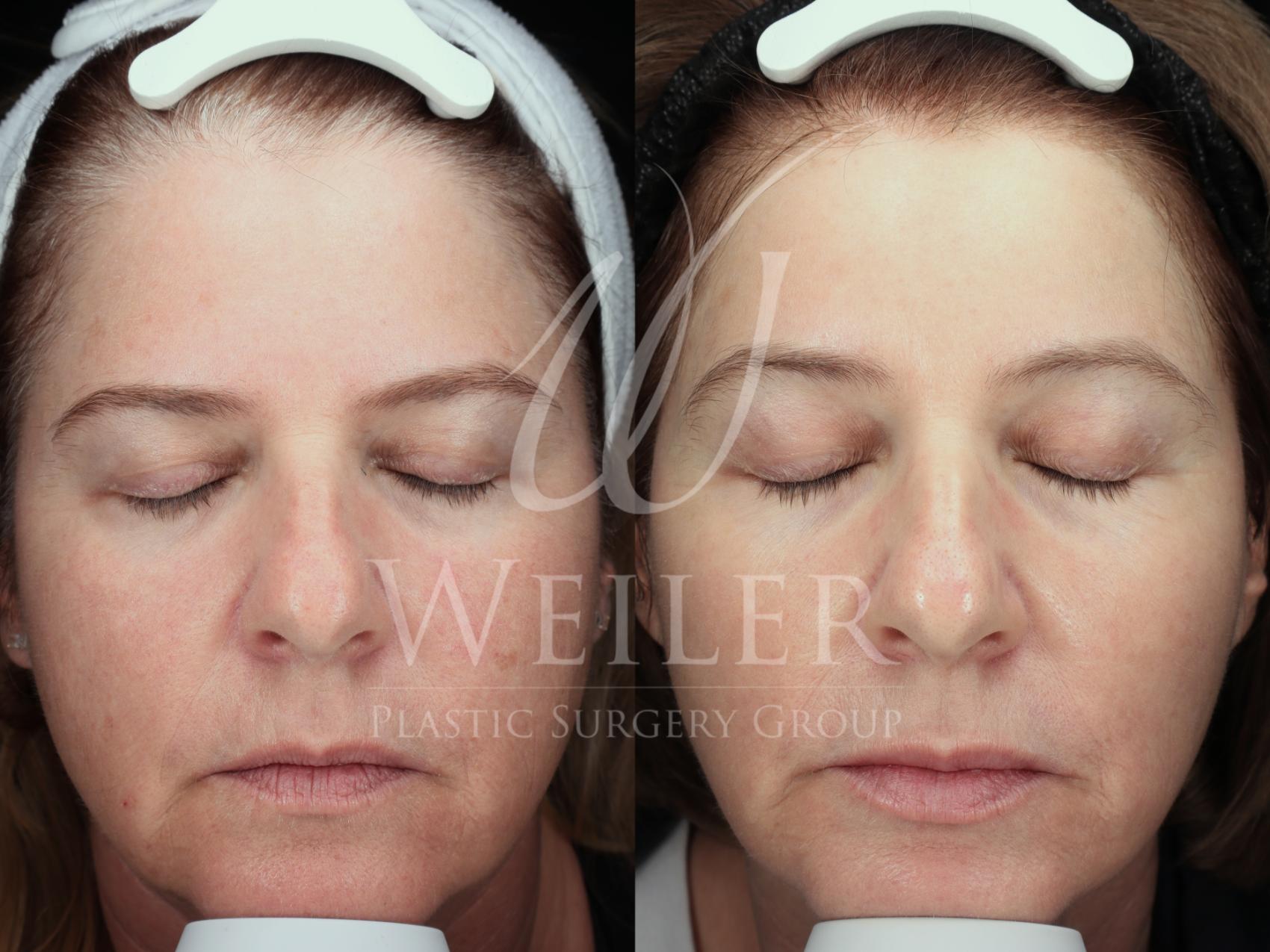 Before & After Genius® Microneedling with RF Case 1478 Front View in Baton Rouge, New Orleans, & Lafayette, Louisiana