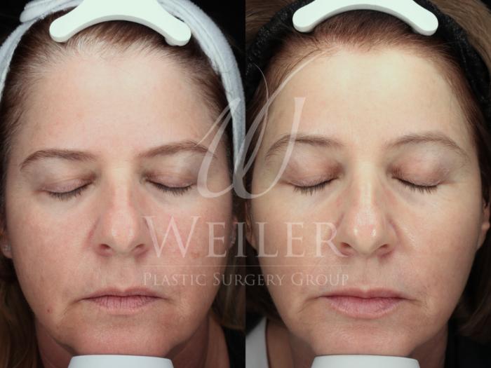 Before & After Genius® Microneedling with RF Case 1478 Front View in Baton Rouge, New Orleans, & Lafayette, Louisiana