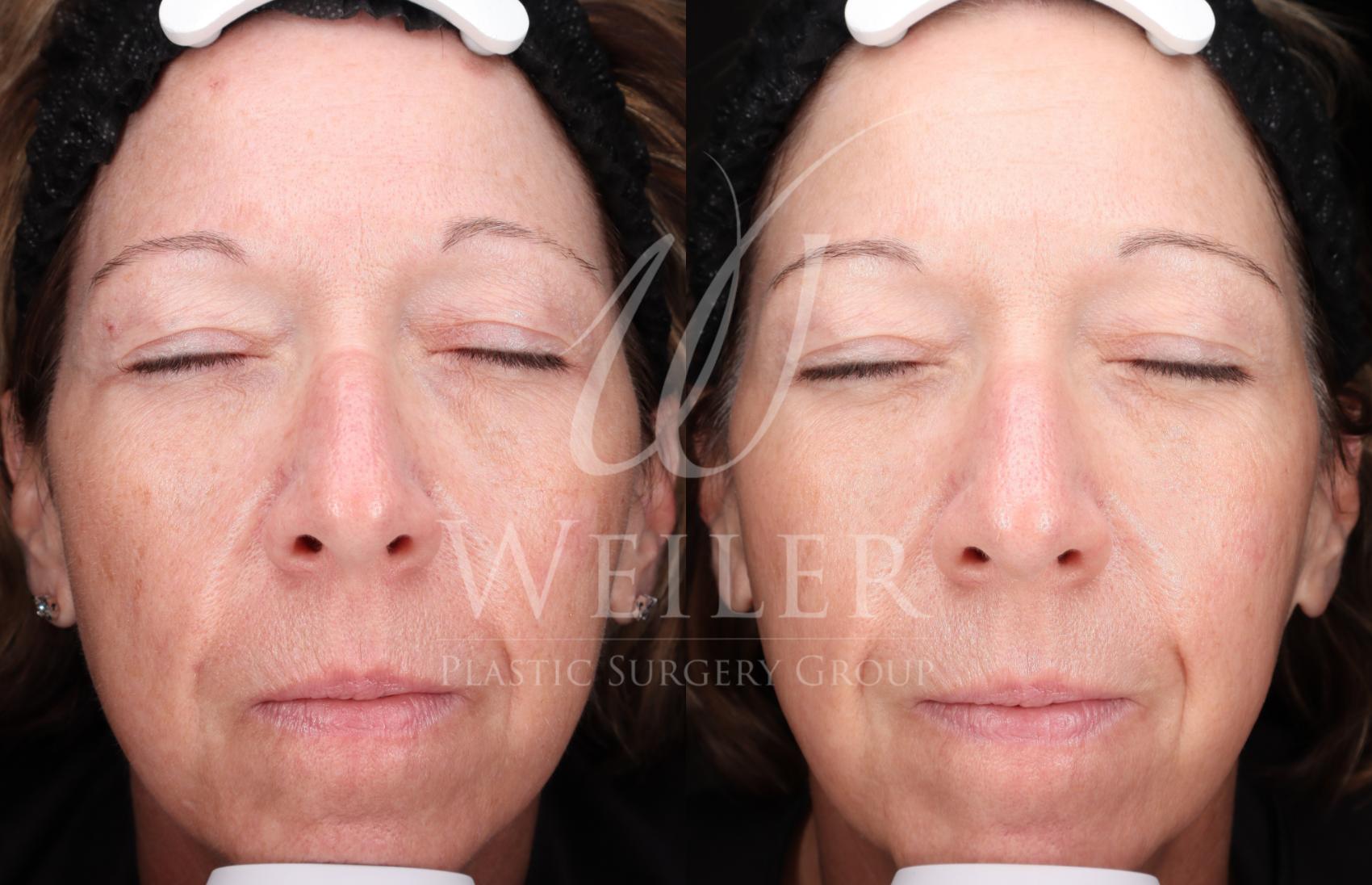 Before & After Lutronic Ultra™ Laser  Case 1482 Front View in Baton Rouge, New Orleans, & Lafayette, Louisiana