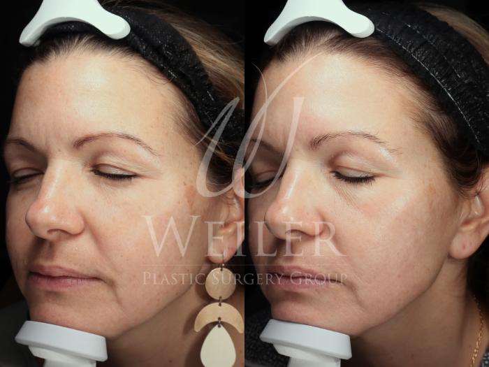 Before & After Lutronic Ultra™ Laser  Case 1484 Left Side View in Baton Rouge, New Orleans, & Lafayette, Louisiana