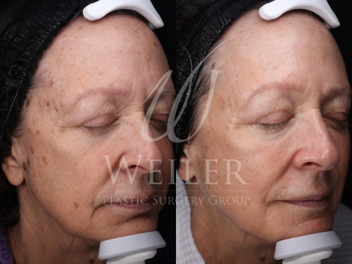 Before & After Lutronic Ultra™ Laser  Case 1684 Right Oblique View in Baton Rouge, New Orleans, & Lafayette, Louisiana
