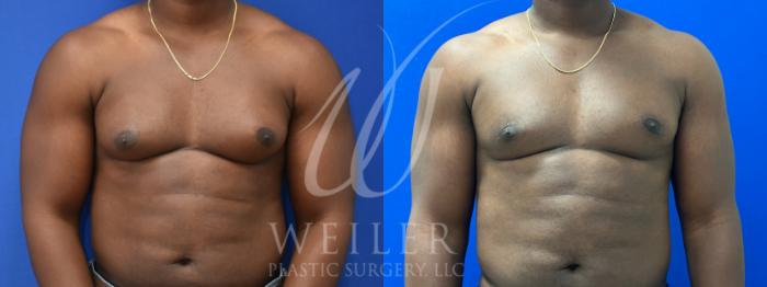 Before & After Male Breast Reduction Case 1006 Front View in Baton Rouge, Louisiana