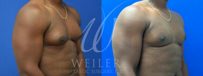 Before & After Male Breast Reduction Case 1006 Right Oblique View in Baton Rouge, Louisiana