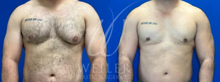 Before & After Male Breast Reduction Case 1102 Front View in Baton Rouge, New Orleans, & Lafayette, Louisiana