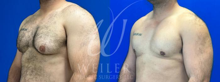 Before & After Male Breast Reduction Case 1102 Left Oblique View in Baton Rouge, New Orleans, & Lafayette, Louisiana