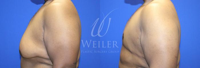 Before & After Male Breast Reduction Case 1141 Left Side View in Baton Rouge, New Orleans, & Lafayette, Louisiana