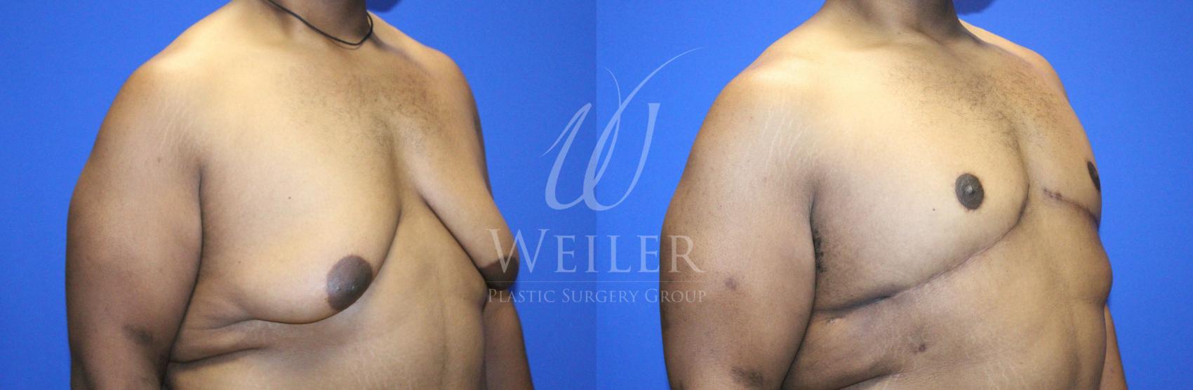 Before & After Male Breast Reduction Case 1141 Right Oblique View in Baton Rouge, New Orleans, & Lafayette, Louisiana