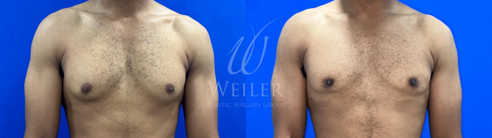 Before & After Male Breast Reduction Case 1169 Front View in Baton Rouge, New Orleans, & Lafayette, Louisiana