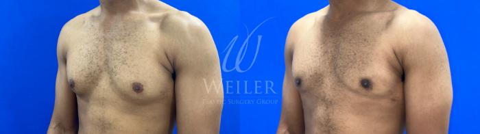 Before & After Male Breast Reduction Case 1169 Right Oblique View in Baton Rouge, New Orleans, & Lafayette, Louisiana