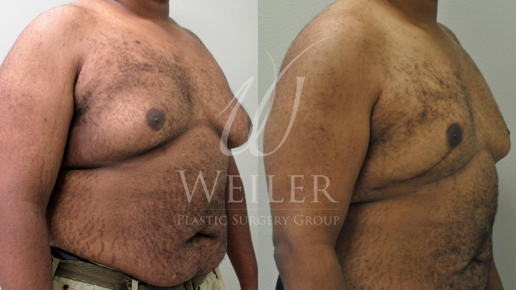 Before & After Male Breast Reduction Case 170 View #1 View in Baton Rouge, Louisiana