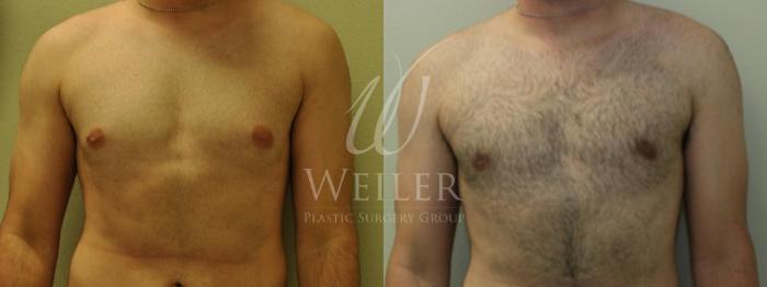 Before & After Male Breast Reduction Case 232 View #1 View in Baton Rouge, New Orleans, & Lafayette, Louisiana