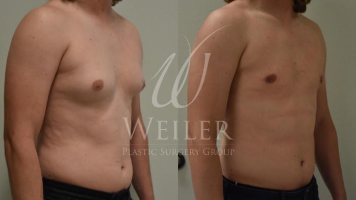Before & After Male Breast Reduction Case 251 View #1 View in Baton Rouge, New Orleans, & Lafayette, Louisiana
