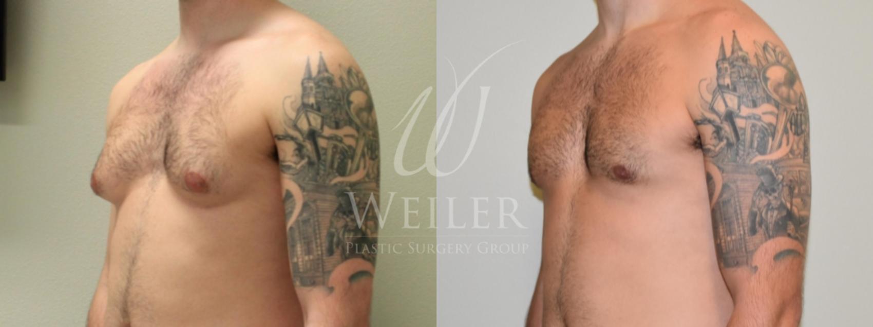 Before & After Male Breast Reduction Case 263 View #1 View in Baton Rouge, New Orleans, & Lafayette, Louisiana