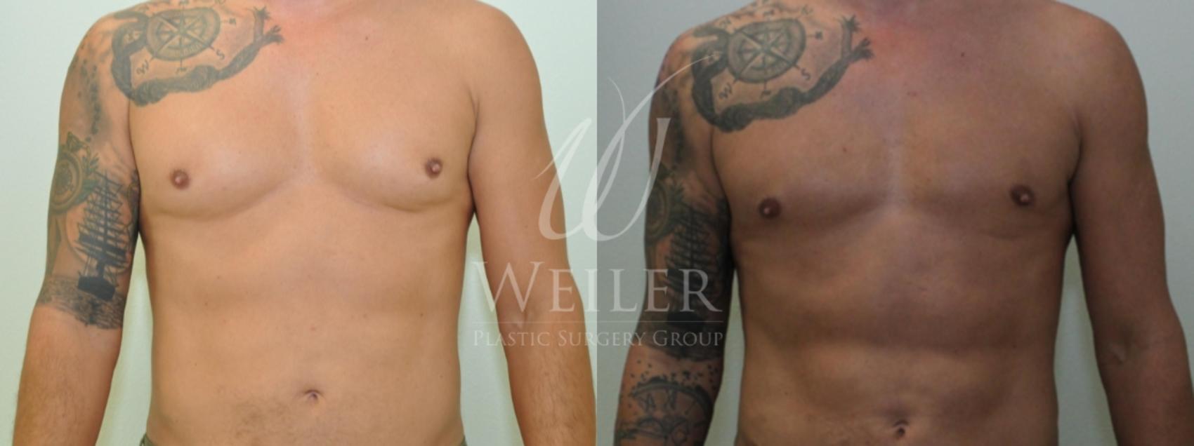 Before & After Male Breast Reduction Case 278 View #1 View in Baton Rouge, Louisiana