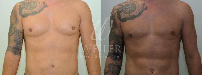 Before & After Male Breast Reduction Case 278 View #1 View in Baton Rouge, New Orleans, & Lafayette, Louisiana