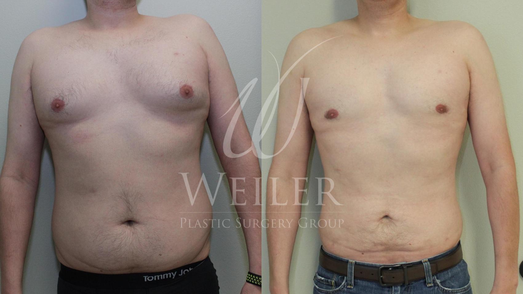 Before & After Male Breast Reduction Case 446 View #1 View in Baton Rouge, Louisiana