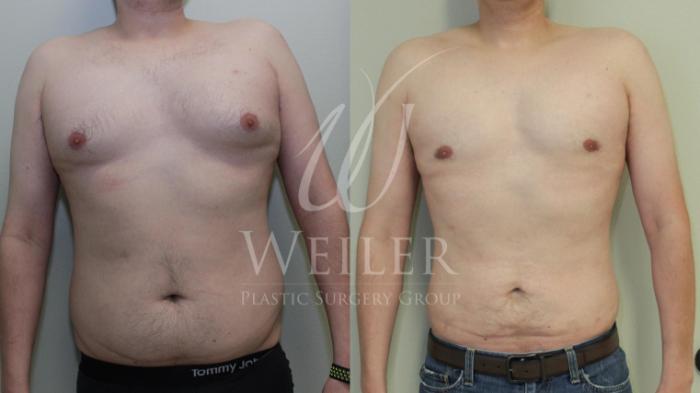 Before & After Male Breast Reduction Case 446 View #1 View in Baton Rouge, New Orleans, & Lafayette, Louisiana
