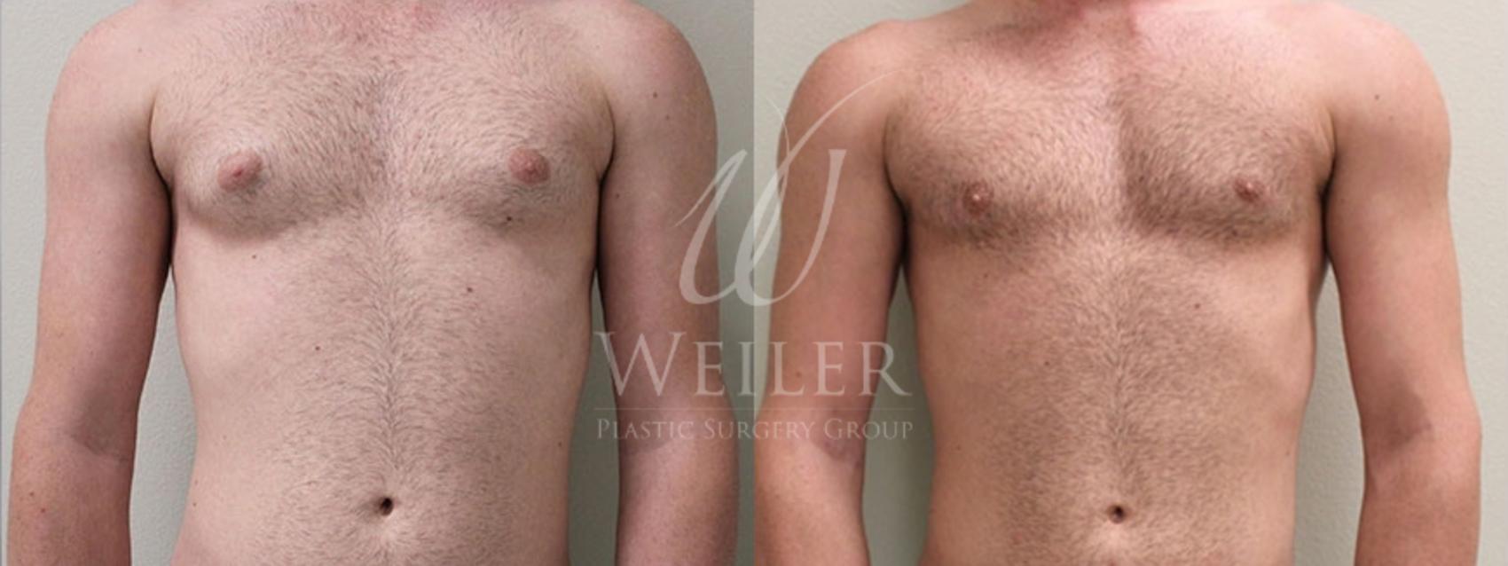 Before & After Male Breast Reduction Case 48 View #1 View in Baton Rouge, New Orleans, & Lafayette, Louisiana