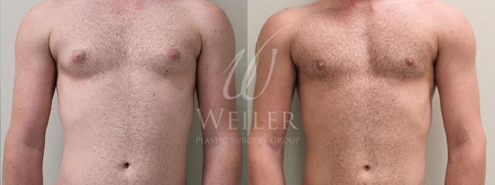 Before & After Male Breast Reduction Case 48 View #1 View in Baton Rouge, Louisiana