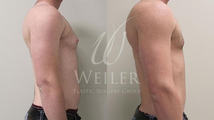 Before & After Male Breast Reduction Case 48 View #2 View in Baton Rouge, New Orleans, & Lafayette, Louisiana