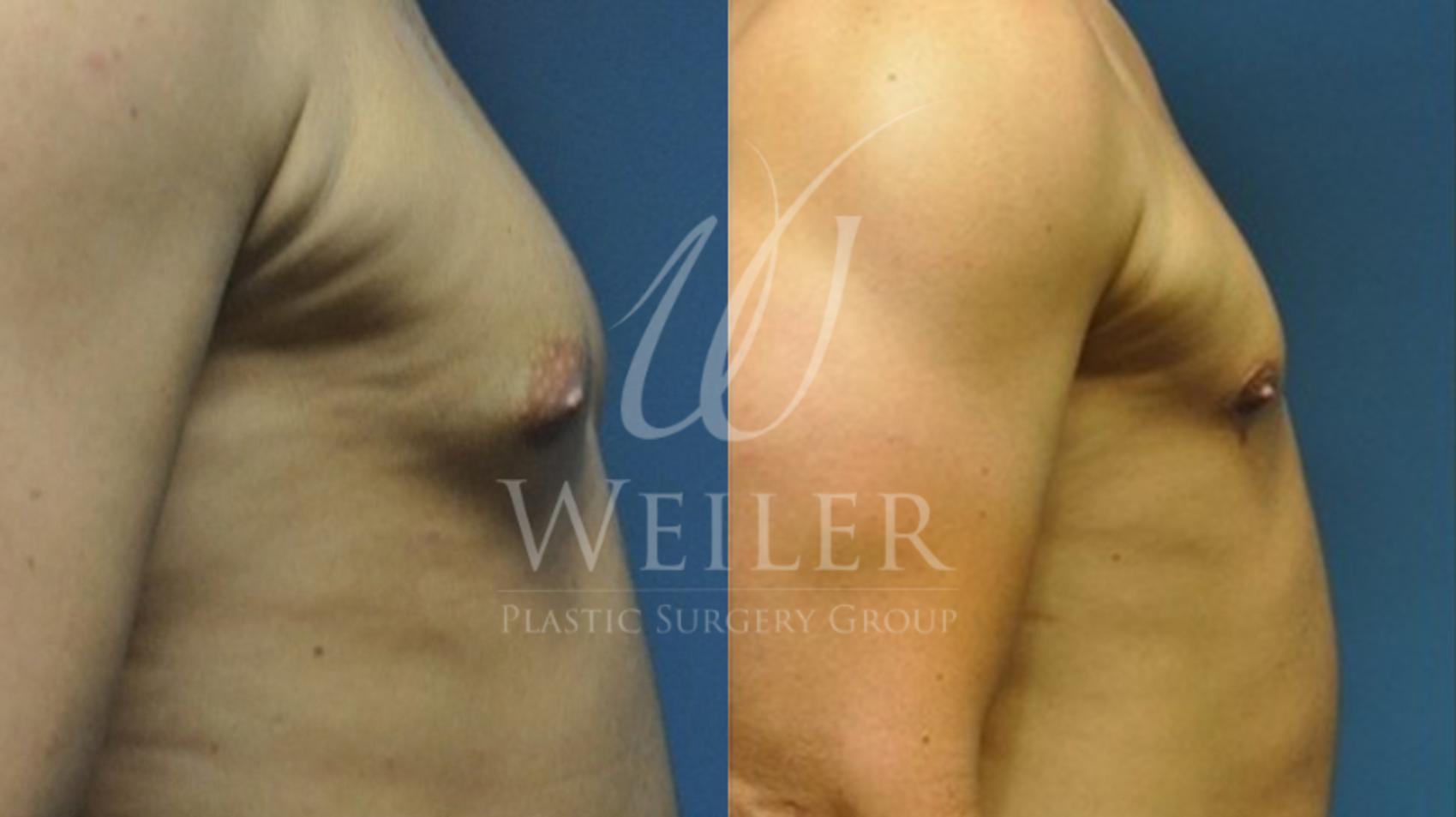 Before & After Male Breast Reduction Case 49 View #1 View in Baton Rouge, Louisiana