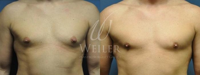 Before & After Male Breast Reduction Case 49 View #2 View in Baton Rouge, New Orleans, & Lafayette, Louisiana