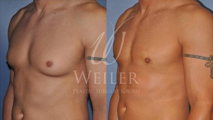 Before & After Male Breast Reduction Case 50 View #1 View in Baton Rouge, Louisiana