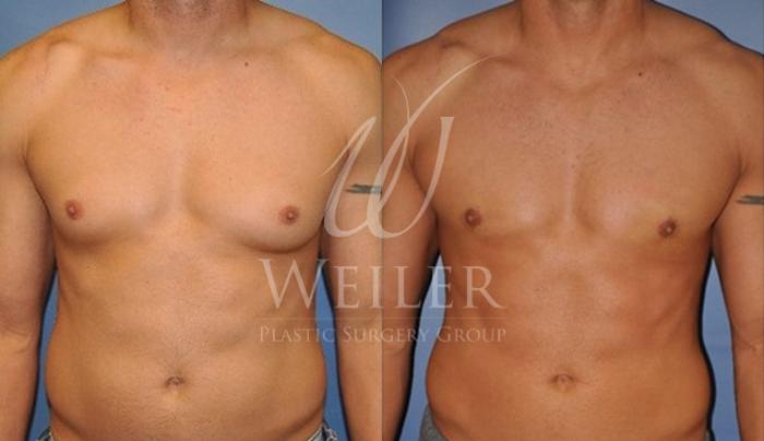 Before & After Male Breast Reduction Case 50 View #2 View in Baton Rouge, New Orleans, & Lafayette, Louisiana