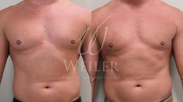 Before & After Male Breast Reduction Case 51 View #1 View in Baton Rouge, Louisiana