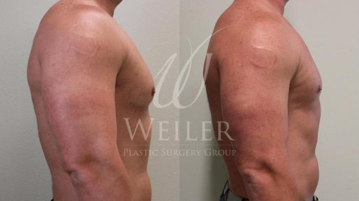 Before & After Male Breast Reduction Case 51 View #2 View in Baton Rouge, Louisiana