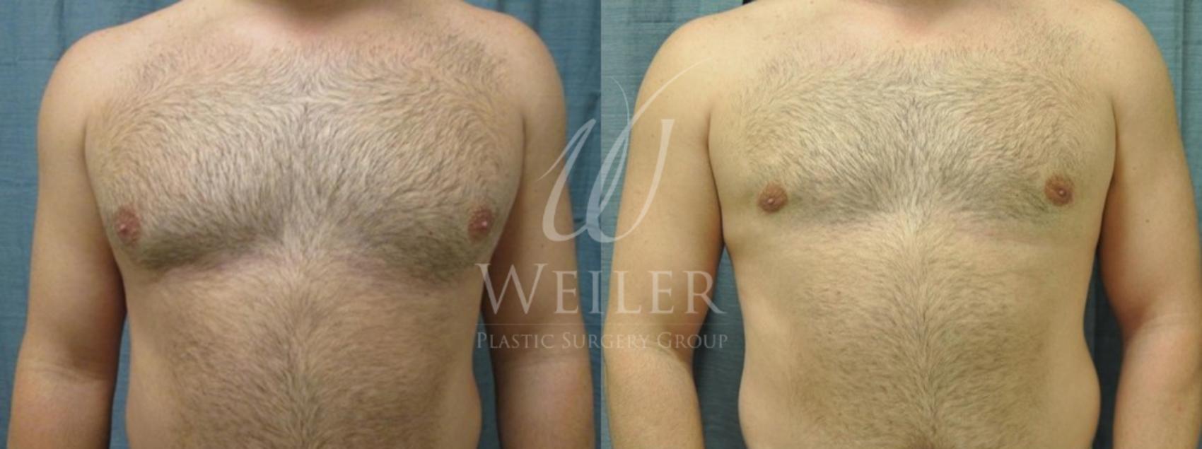 Before & After Male Breast Reduction Case 52 View #1 View in Baton Rouge, Louisiana