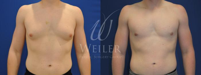Before & After Male Breast Reduction Case 527 Front View in Baton Rouge, Louisiana