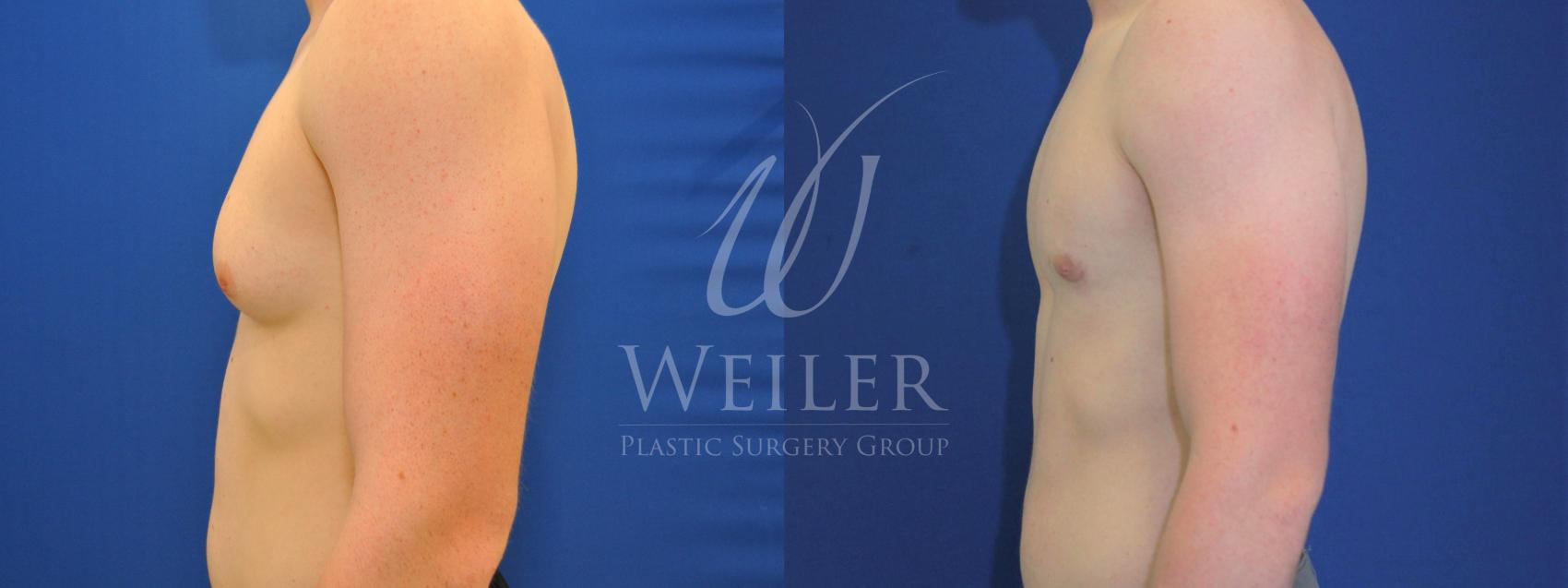 Before & After Male Breast Reduction Case 527 Left Side View in Baton Rouge, Louisiana