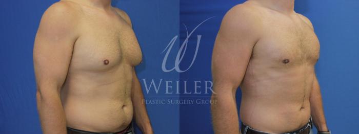 Before & After Male Breast Reduction Case 528 Right Oblique View in Baton Rouge, Louisiana