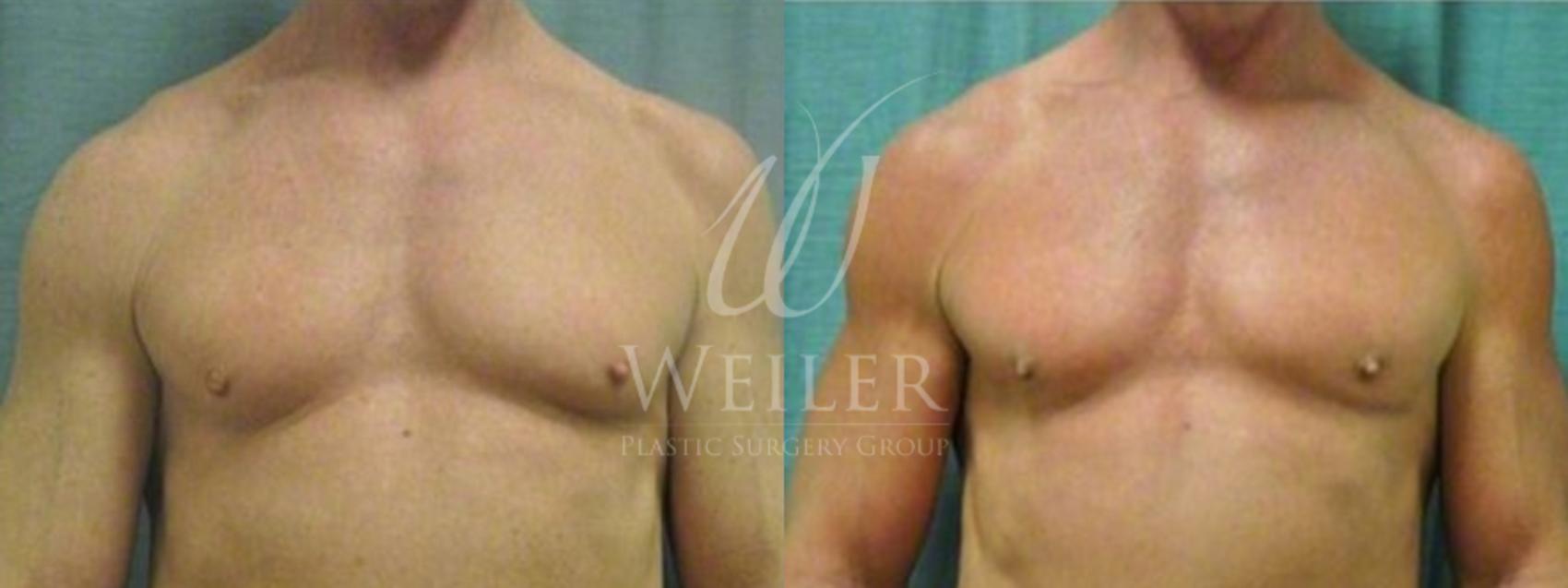 Before & After Male Breast Reduction Case 53 View #1 View in Baton Rouge, Louisiana