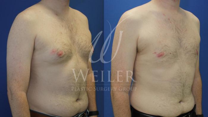 Before & After Male Breast Reduction Case 546 Right Oblique View in Baton Rouge, Louisiana