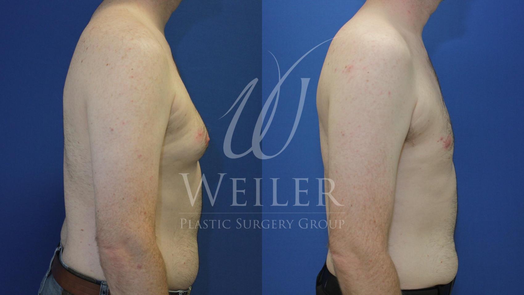 Before & After Male Breast Reduction Case 546 Right Side View in Baton Rouge, Louisiana