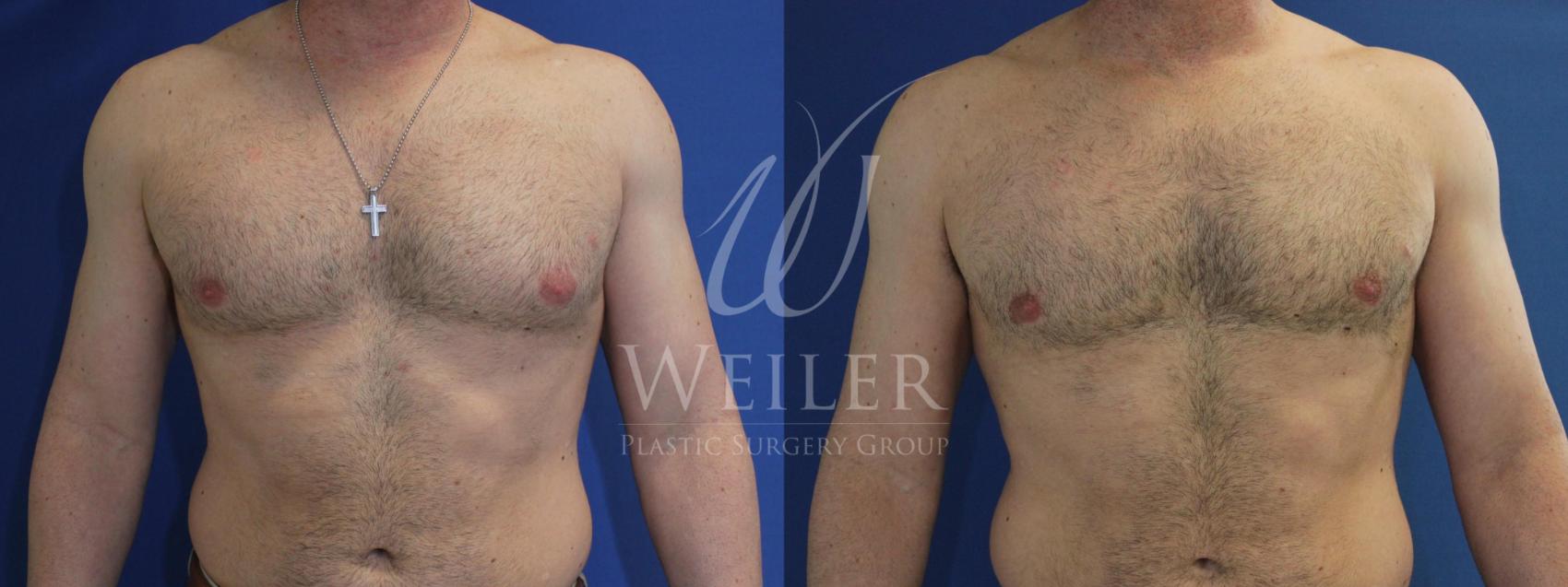Before & After Male Breast Reduction Case 556 Front View in Baton Rouge, Louisiana
