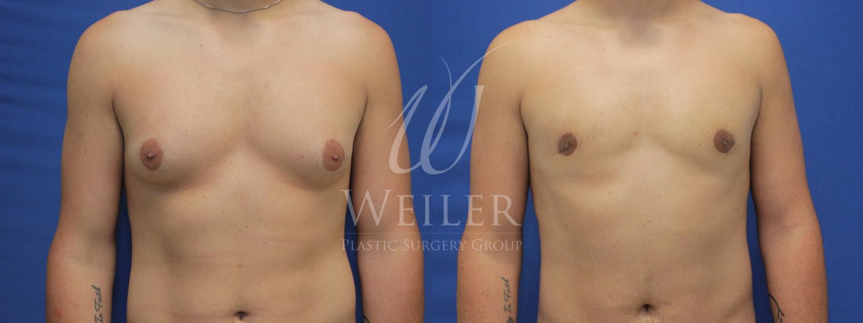 Before & After Male Breast Reduction Case 641 Front View in Baton Rouge, Louisiana