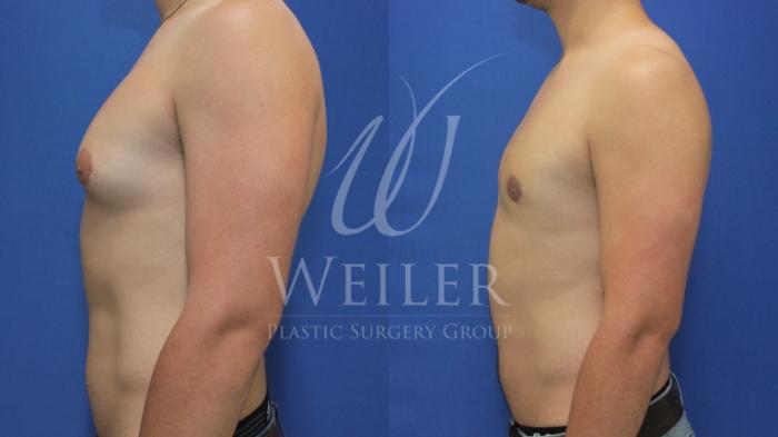 Before & After Male Breast Reduction Case 641 Left Side View in Baton Rouge, Louisiana