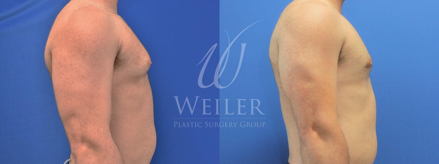 Before & After Male Breast Reduction Case 759 Right Side View in Baton Rouge, Louisiana