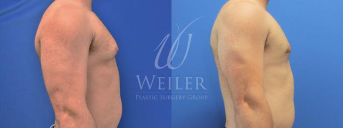 Before & After Male Breast Reduction Case 759 Right Side View in Baton Rouge, Louisiana