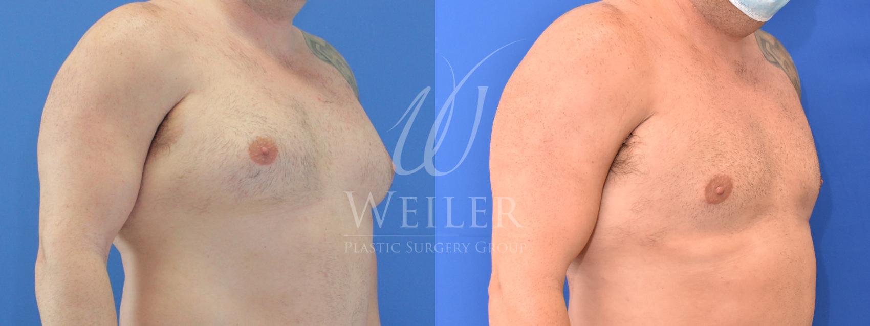 Before & After Male Breast Reduction Case 771 Right Oblique View in Baton Rouge, Louisiana